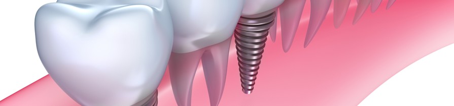 Zobni vsadki - implantati
