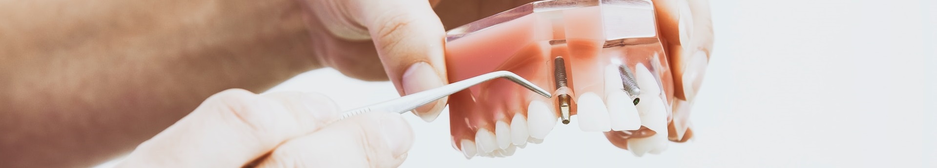 Postopek vstavljanja zobnega implantata