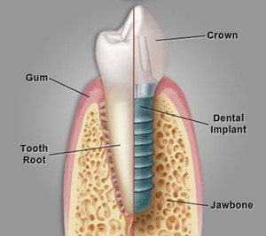 Prednosti zobnih implantatov
