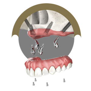 All-on-4 metoda zobnega implantiranja