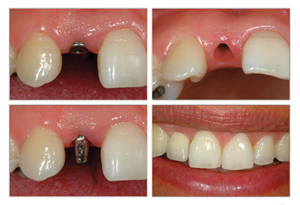Operativni poseg - zobni implantat
