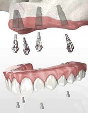 Subperiostalni zobni implanatati 